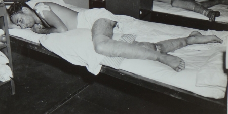 Clarence E. McElroy, S1c USNR (badly burned legs), survivor of the USS Indianapolis in Naval Base Hospital No. 20, Peleliu, 5 August 1945.