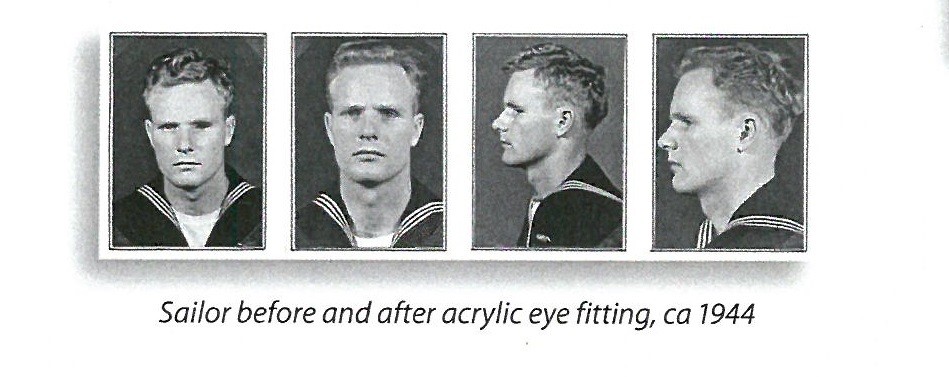 jpeg photo showing four views of a sailor before and after acrylic eye fitting, ca 1944