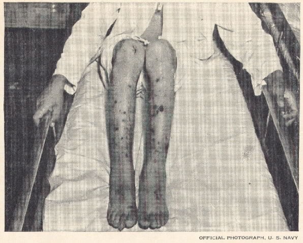 Figure 3.--"Immersion Foot." Salt water caused these sores on the legs of an airman rescued by a U. S. destroyer after seven days on a life raft. [Official Photograph U.S. Navy]